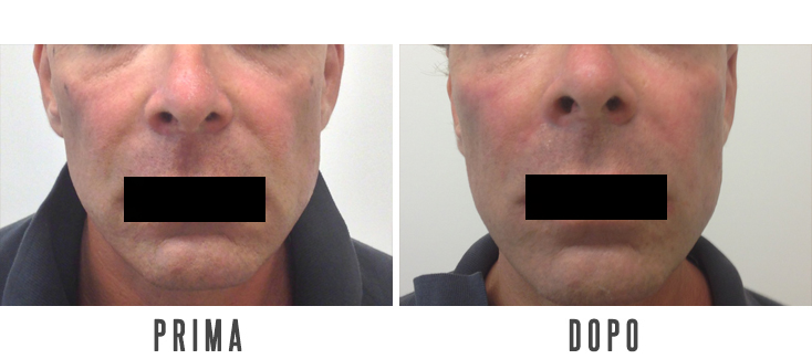PREVENZIONE DELL'INVECCHIAMENTO CUTANEO E CORREZIONE DELLE RUGHE