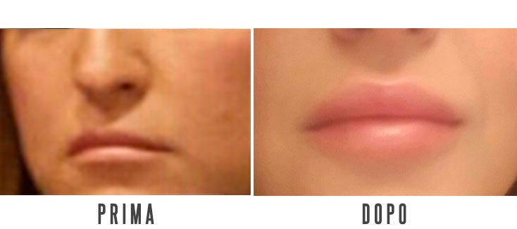 Labbra - prima e dopo trattamento con acido ialuronico